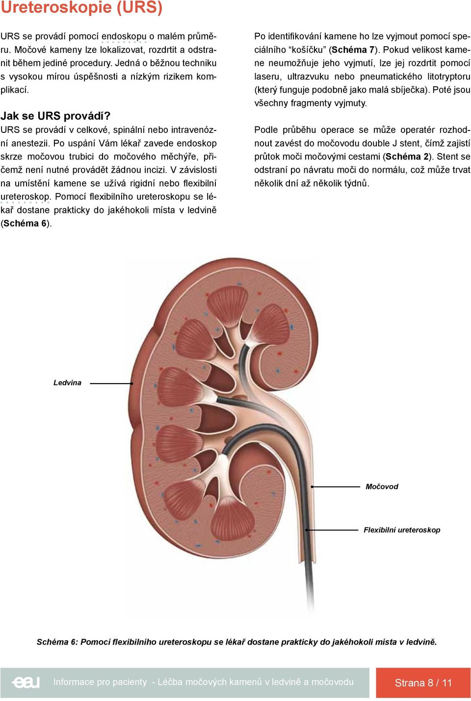 Po uspání Vám lékař zavede endoskop skrze močovou trubici do močového měchýře, přičemž není nutné provádět žádnou incizi. V závislosti na umístění kamene se užívá rigidní nebo flexibilní ureteroskop.