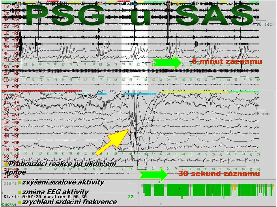 aktivity změna EEG aktivity