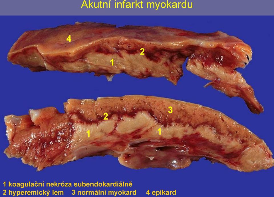 lem 3 normální myokard 4