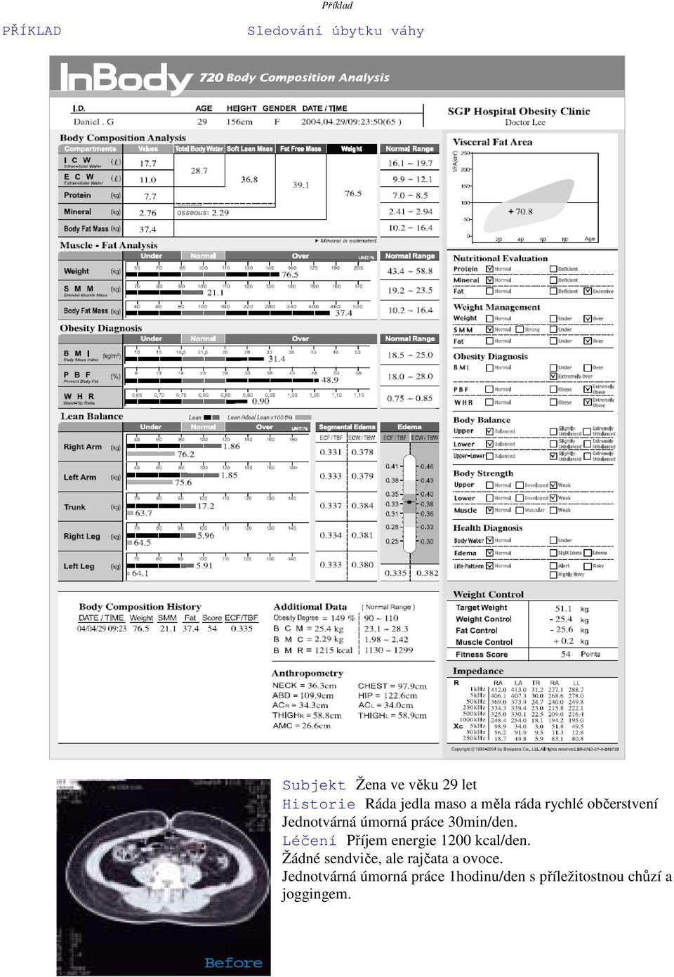 30min/den. Léčení Příjem energie 1200 kcal/den.
