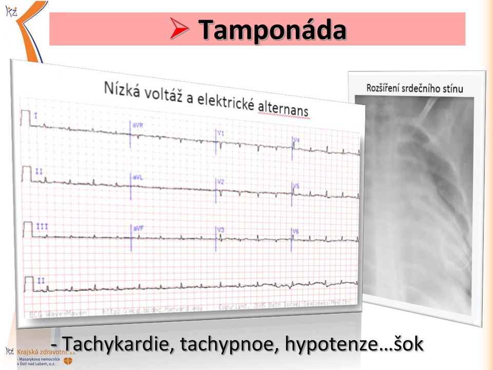 (malá senzitivita, vysoká specificita /pouze pokud se obě komory plní
