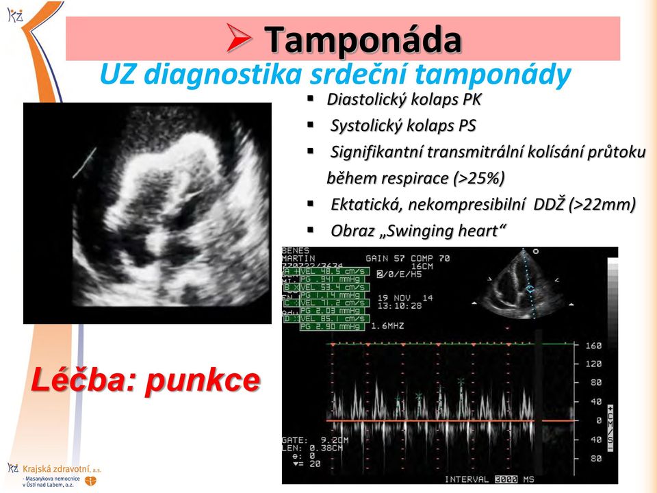 transmitrální kolísání průtoku během respirace (>25%)
