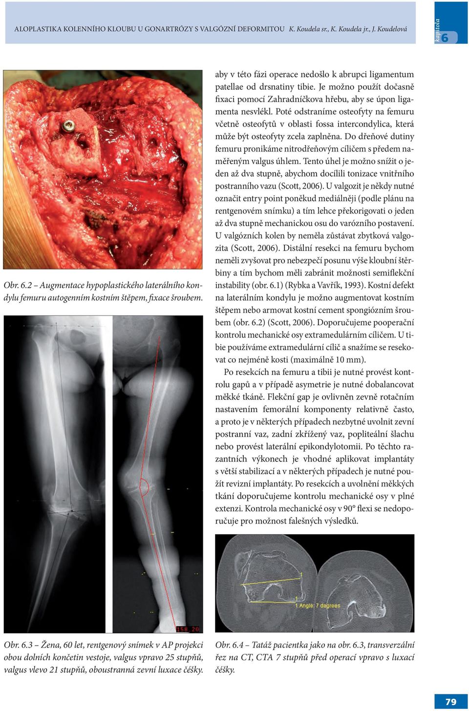 Je možno použít dočasně fixaci pomocí Zahradníčkova hřebu, aby se úpon ligamenta nesvlékl.