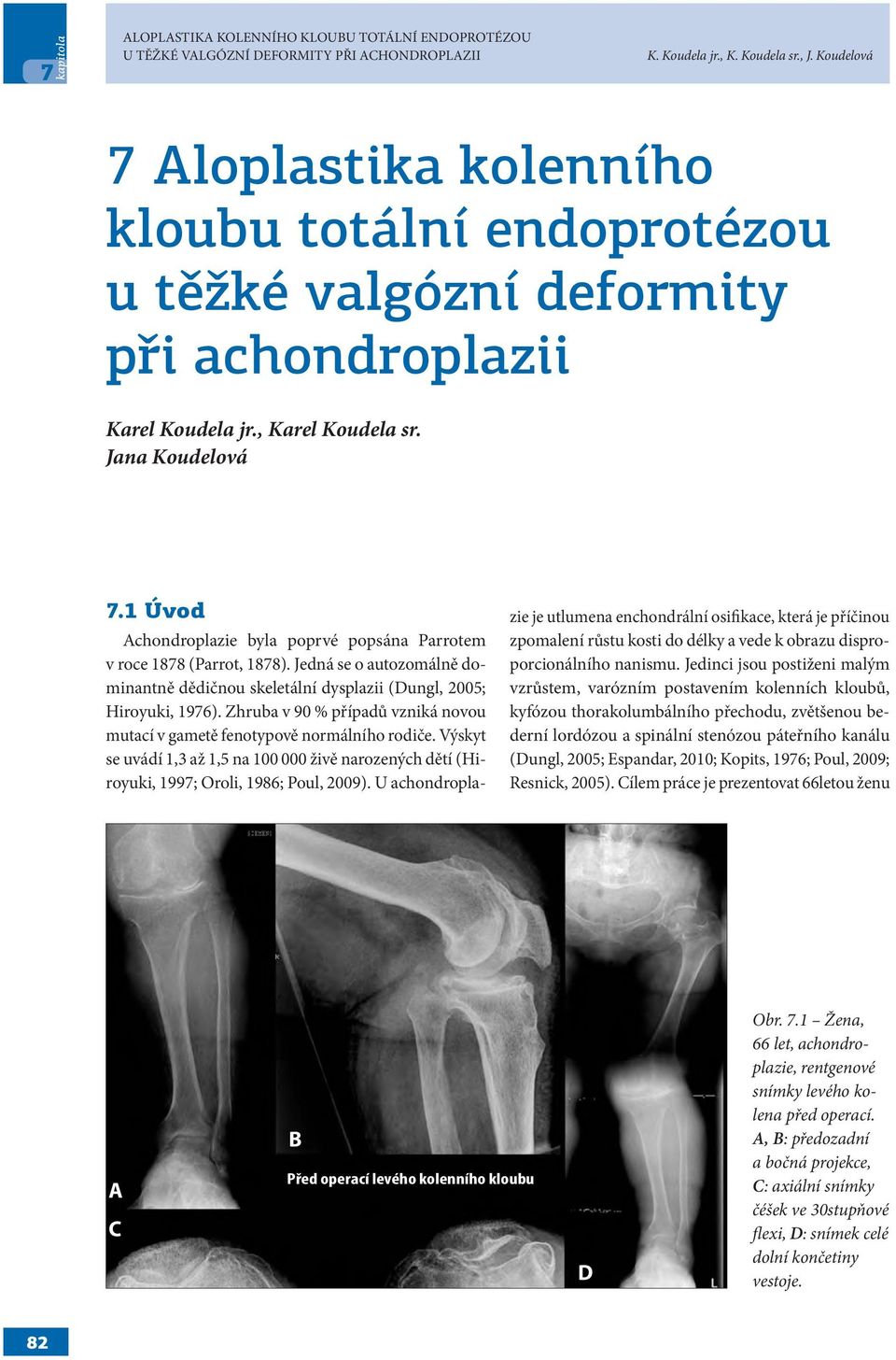 1 Úvod Achondroplazie byla poprvé popsána Parrotem v roce 1878 (Parrot, 1878). Jedná se o autozomálně dominantně dědičnou skeletální dysplazii (Dungl, 2005; Hiroyuki, 1976).