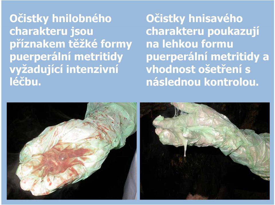 Očistky hnisavého charakteru poukazují na lehkou formu