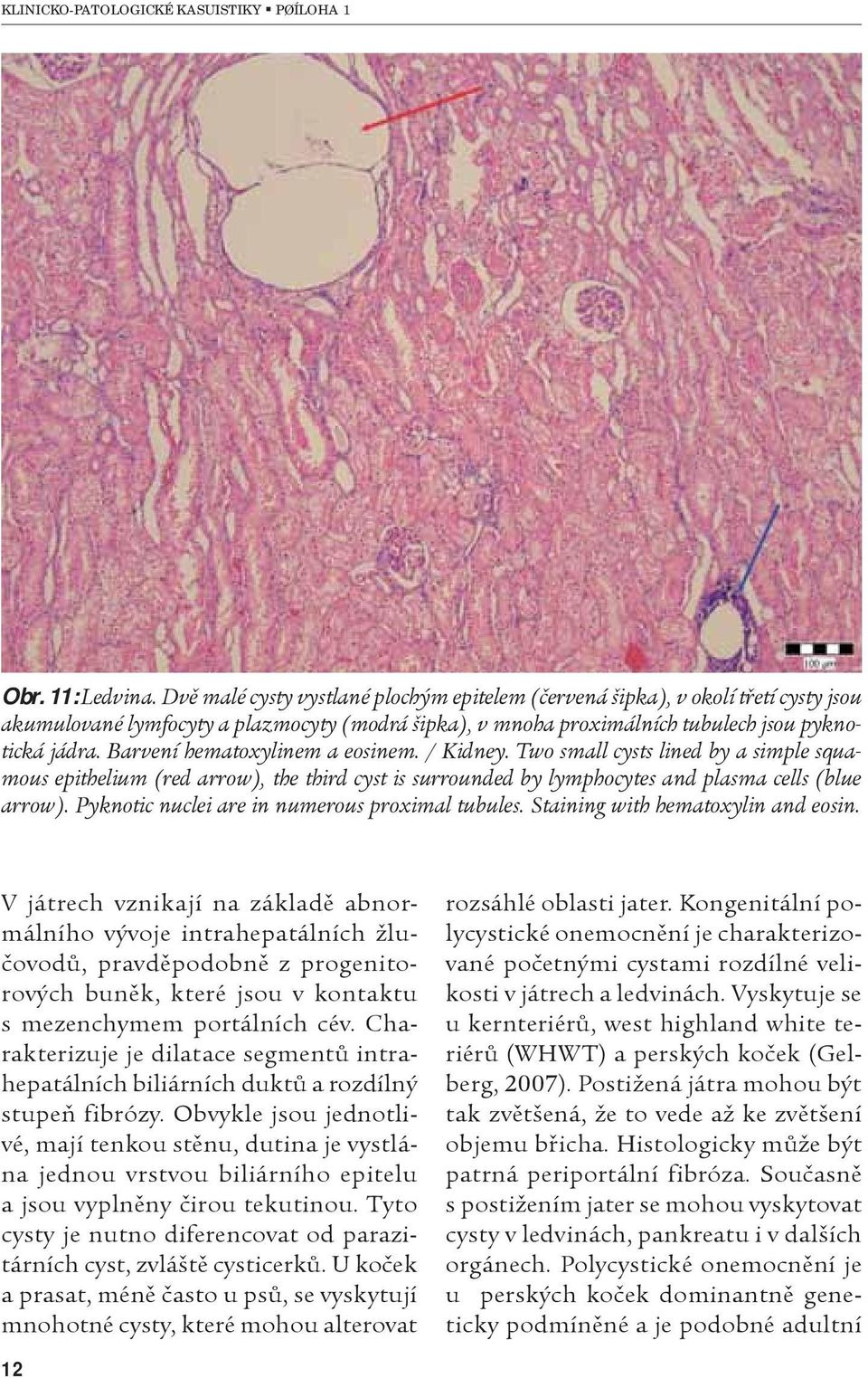 Barvení hematoxylinem a eosinem. / Kidney. Two small cysts lined by a simple squamous epithelium (red arrow), the third cyst is surrounded by lymphocytes and plasma cells (blue arrow).