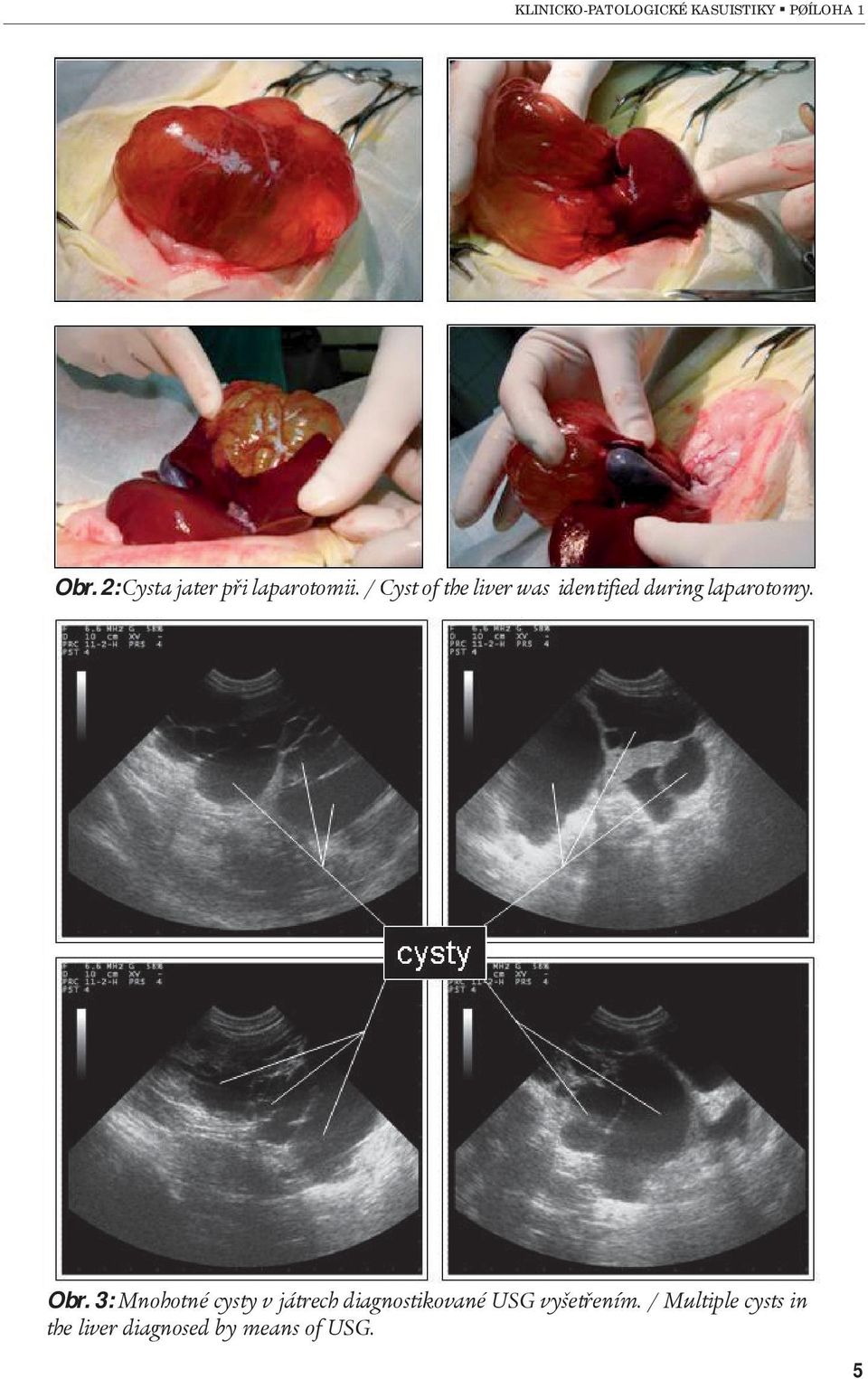 Obr. 3: Mnohotné cysty v játrech diagnostikované USG