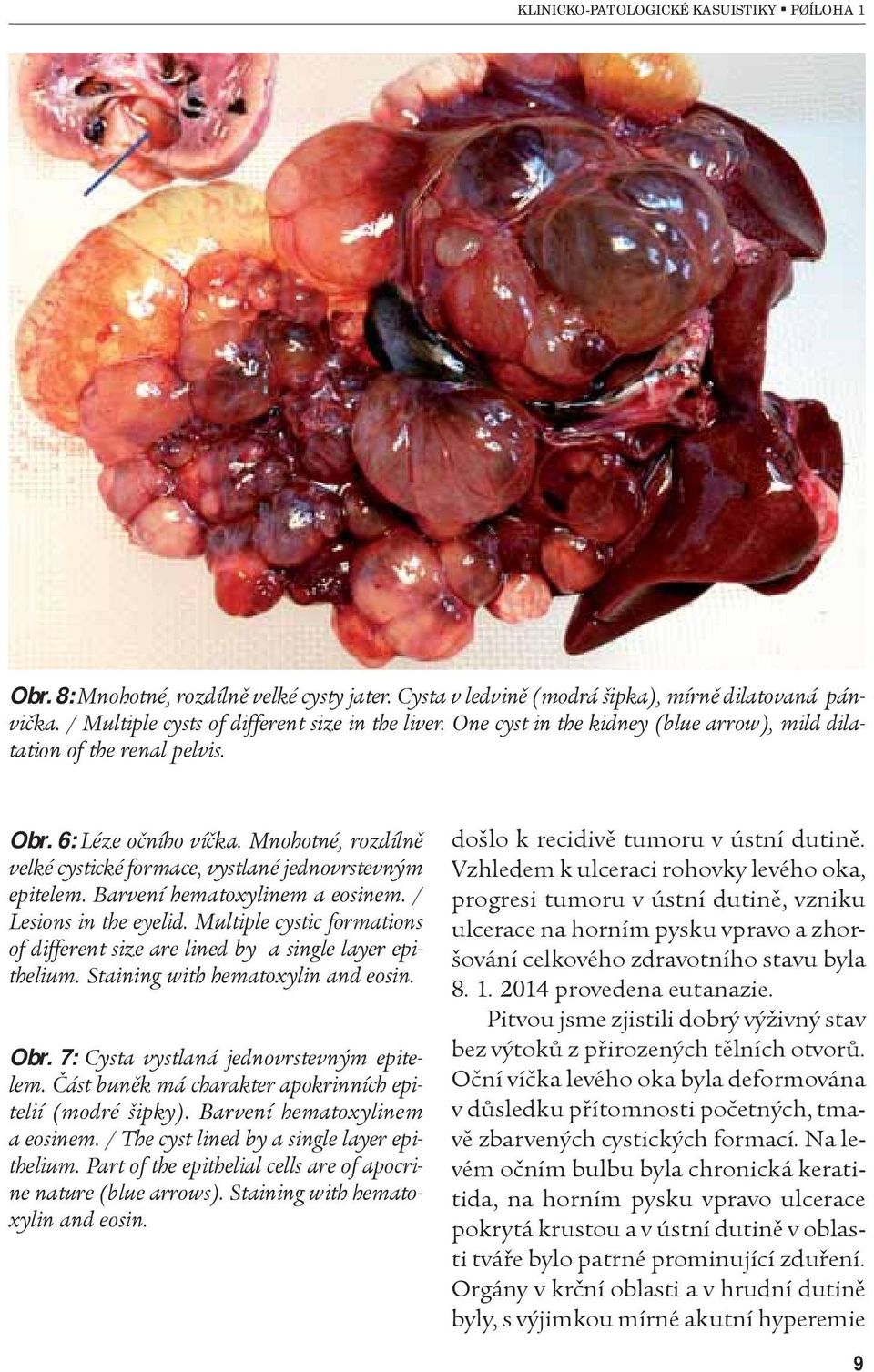 Barvení hematoxylinem a eosinem. / Lesions in the eyelid. Multiple cystic formations of different size are lined by a single layer epithelium. Staining with hematoxylin and eosin. Obr.