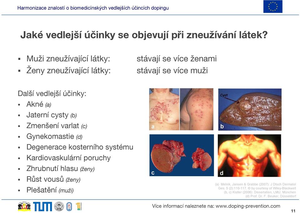 cysty (b) Zmenšení varlat (c) Gynekomastie (d) Degenerace kosterního systému Kardiovaskulární poruchy Zhrubnutí hlasu (ženy) Růst vousů