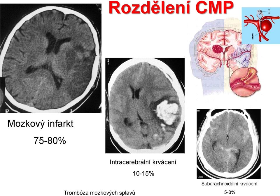 10-15% Trombóza mozkových