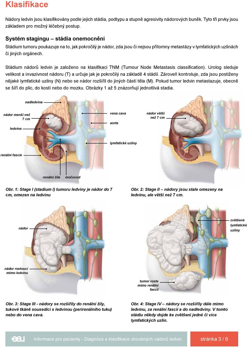 Stádium nádorů ledvin je založeno na klasifikaci TNM (Tumour Node Metastasis classification). Urolog sleduje velikost a invazivnost nádoru (T) a určuje jak je pokročilý na základě 4 stádií.