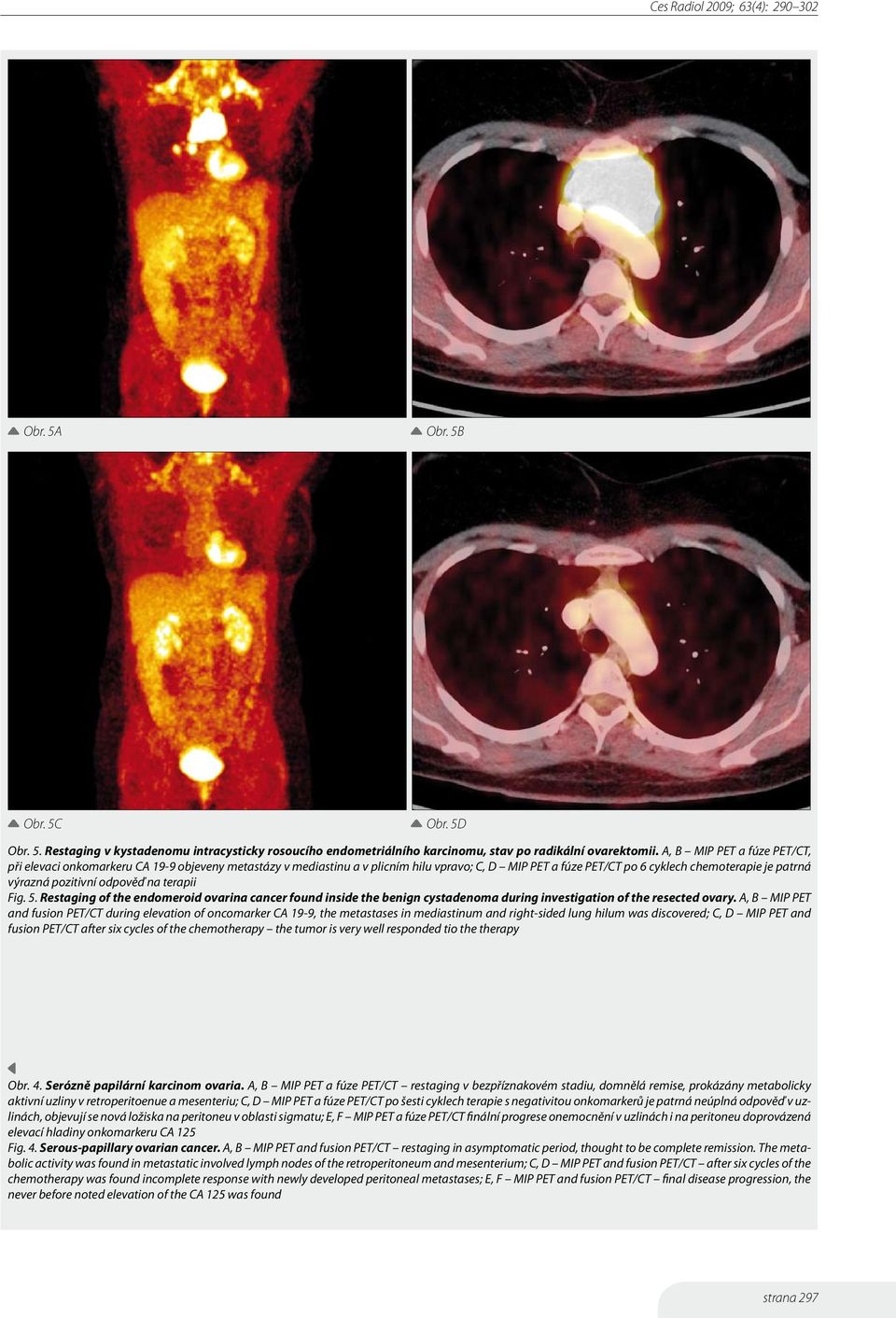 odpověď na terapii Fig. 5. Restaging of the endomeroid ovarina cancer found inside the benign cystadenoma during investigation of the resected ovary.
