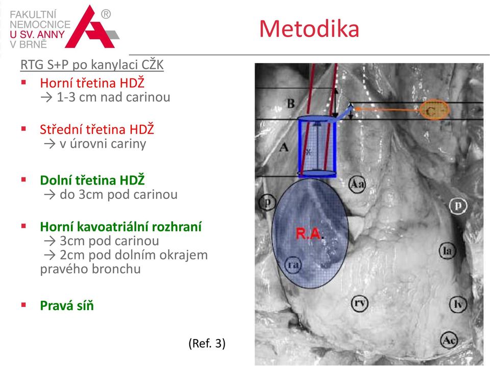 třetina HDŽ do 3cm pod carinou Horní kavoatriální rozhraní