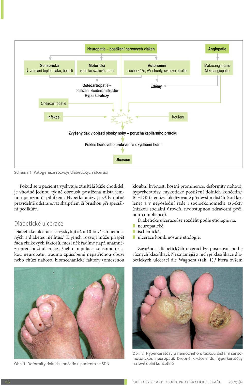 okysličení tkání Ulcerace Schéma 1 Patogeneze rozvoje diabetických ulcerací Pokud se u pacienta vyskytuje ztluštělá kůže chodidel, je vhodné jednou týdně obrousit postižená místa jemnou pemzou či