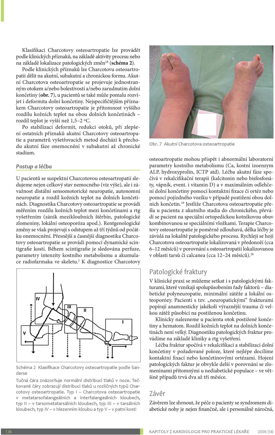 Akutní Charcotova osteoartropatie se projevuje jednostranným otokem a/nebo bolestivostí a/nebo zarudnutím dolní končetiny (obr. 7), u pacientů se také může pomalu rozvíjet i deformita dolní končetiny.