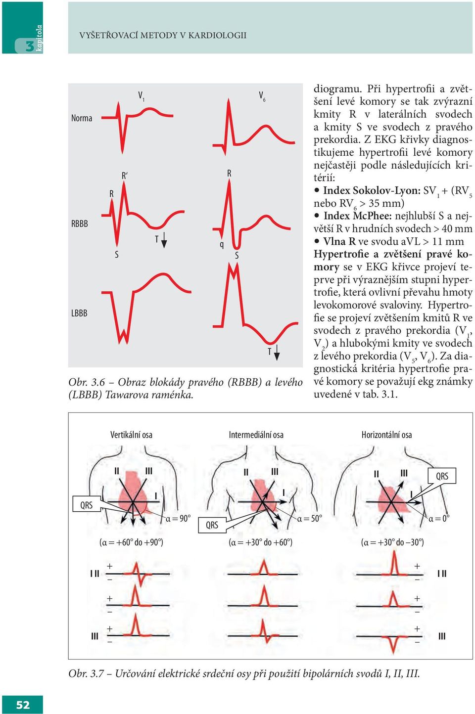 Z EKG křivky diagnostikujeme hypertrofii levé komory nejčastěji podle následujících kritérií: Index Sokolov-Lyon: SV 1 + (RV 5 nebo RV 6 > 35 mm) Index McPhee: nejhlubší S a největší R v hrudních
