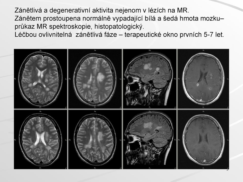 mozku průkaz MR spektroskopie, histopatologický.