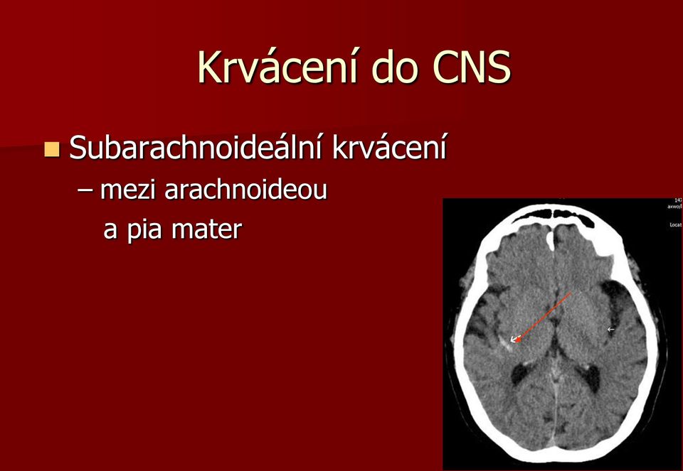 krvácení mezi
