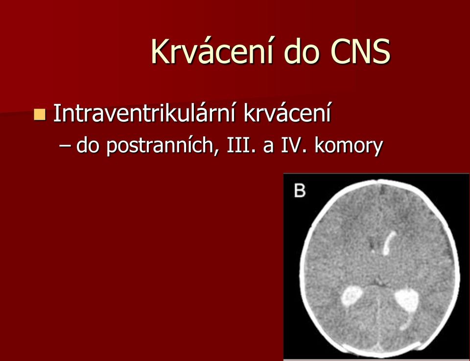 krvácení do