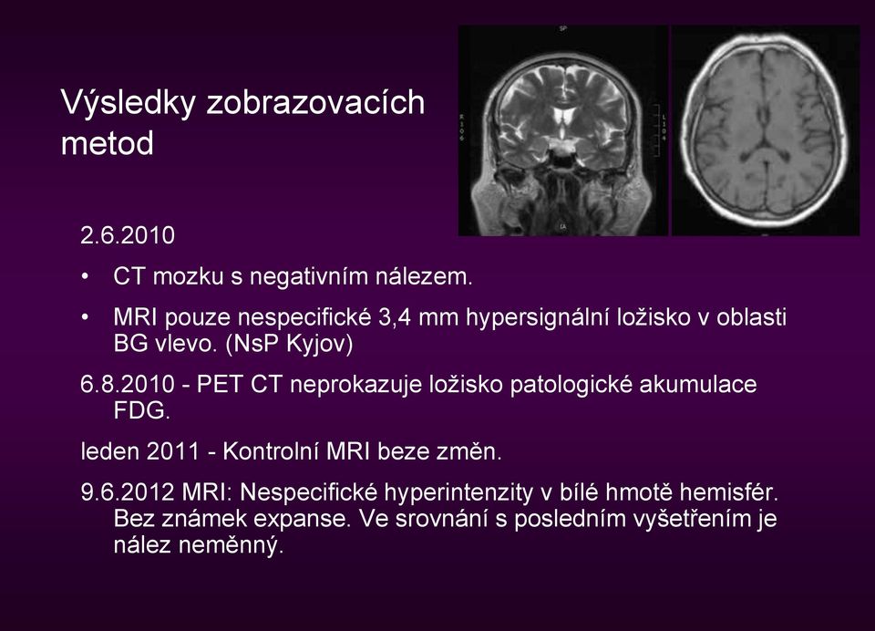 2010 - PET CT neprokazuje ložisko patologické akumulace FDG. leden 2011 - Kontrolní MRI beze změn.