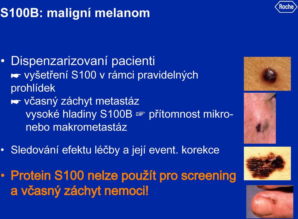 S100B přítomnost mikronebo makrometastáz Sledování efektu léčby a její