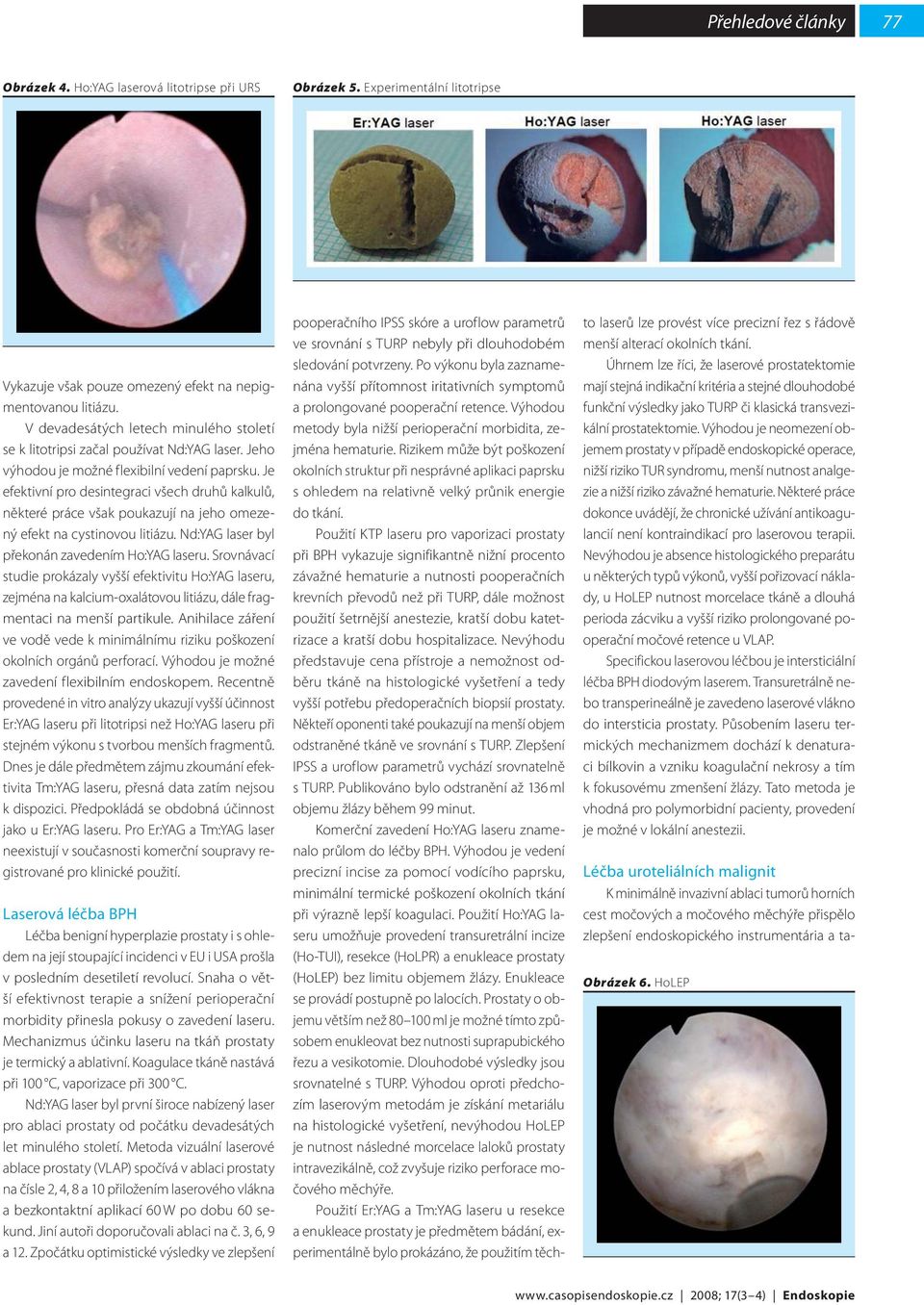 Je efektivní pro desintegraci všech druhů kalkulů, některé práce však poukazují na jeho omezený efekt na cystinovou litiázu. Nd:YAG laser byl překonán zavedením Ho:YAG laseru.