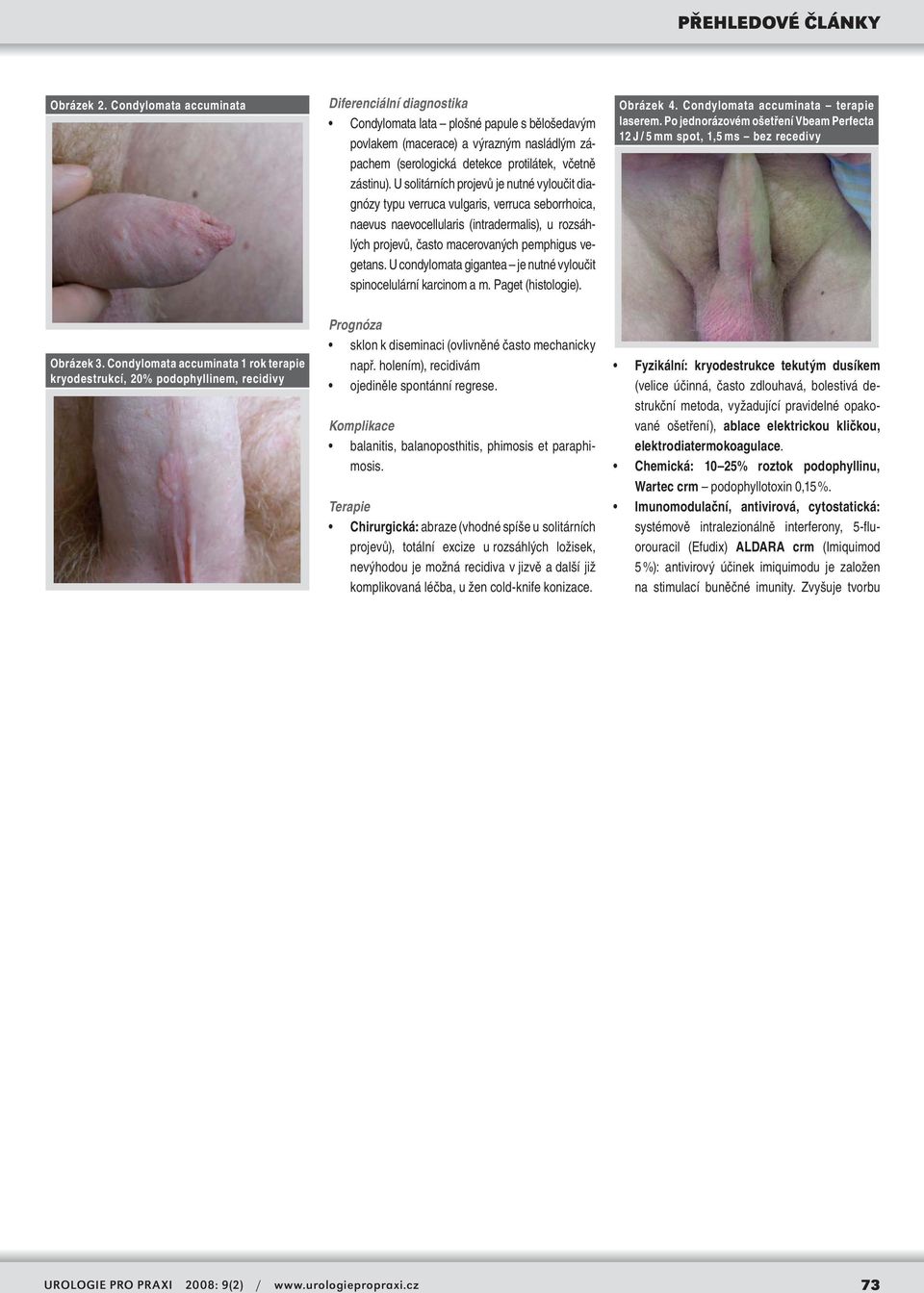 U condylomata gigantea je nutné vyloučit spinocelulární karcinom a m. Paget (histologie). Obrázek 4. Condylomata accuminata terapie laserem.