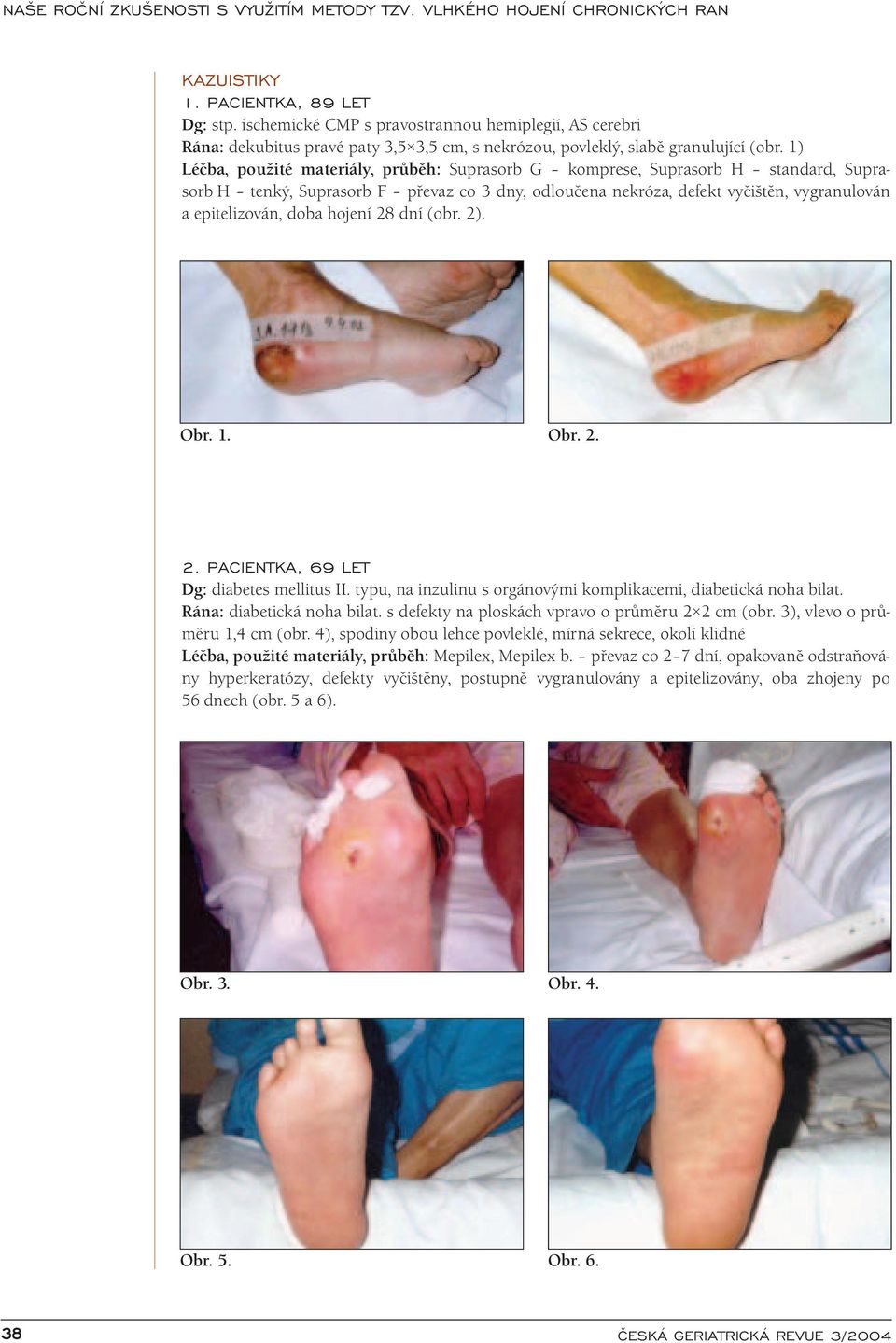hojení 28 dní (obr. 2). Obr. 1. Obr. 2. 2. PACIENTKA, 69 LET Dg: diabetes mellitus II. typu, na inzulinu s orgánovými komplikacemi, diabetická noha bilat. Rána: diabetická noha bilat.
