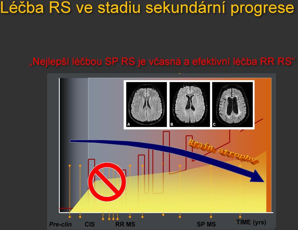 Nejlepší léčbou SP RS