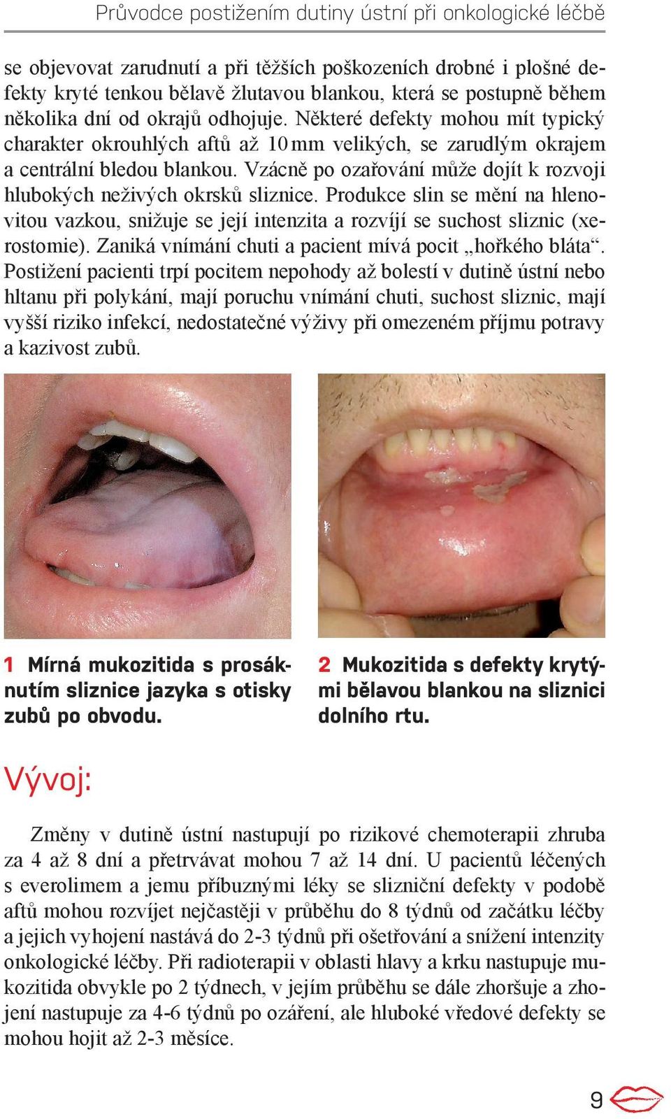 Vzácně po ozařování může dojít k rozvoji hlubokých neživých okrsků sliznice. Produkce slin se mění na hlenovitou vazkou, snižuje se její intenzita a rozvíjí se suchost sliznic (xerostomie).