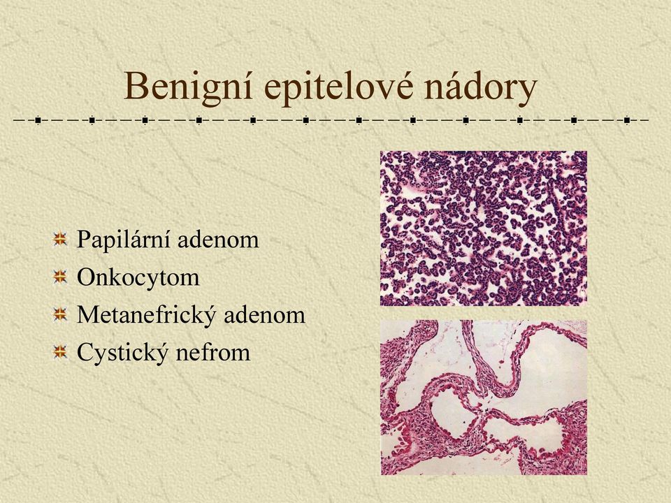 adenom Onkocytom