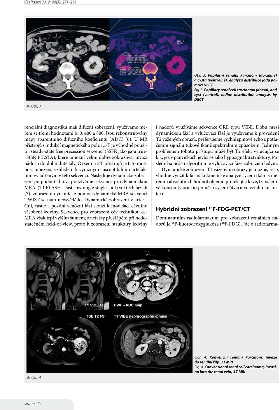 Papilární renální karcinom (dorzálně) a cysta (ventrálně), analýza distribuce jódu pomocí DECT Fig. 3.