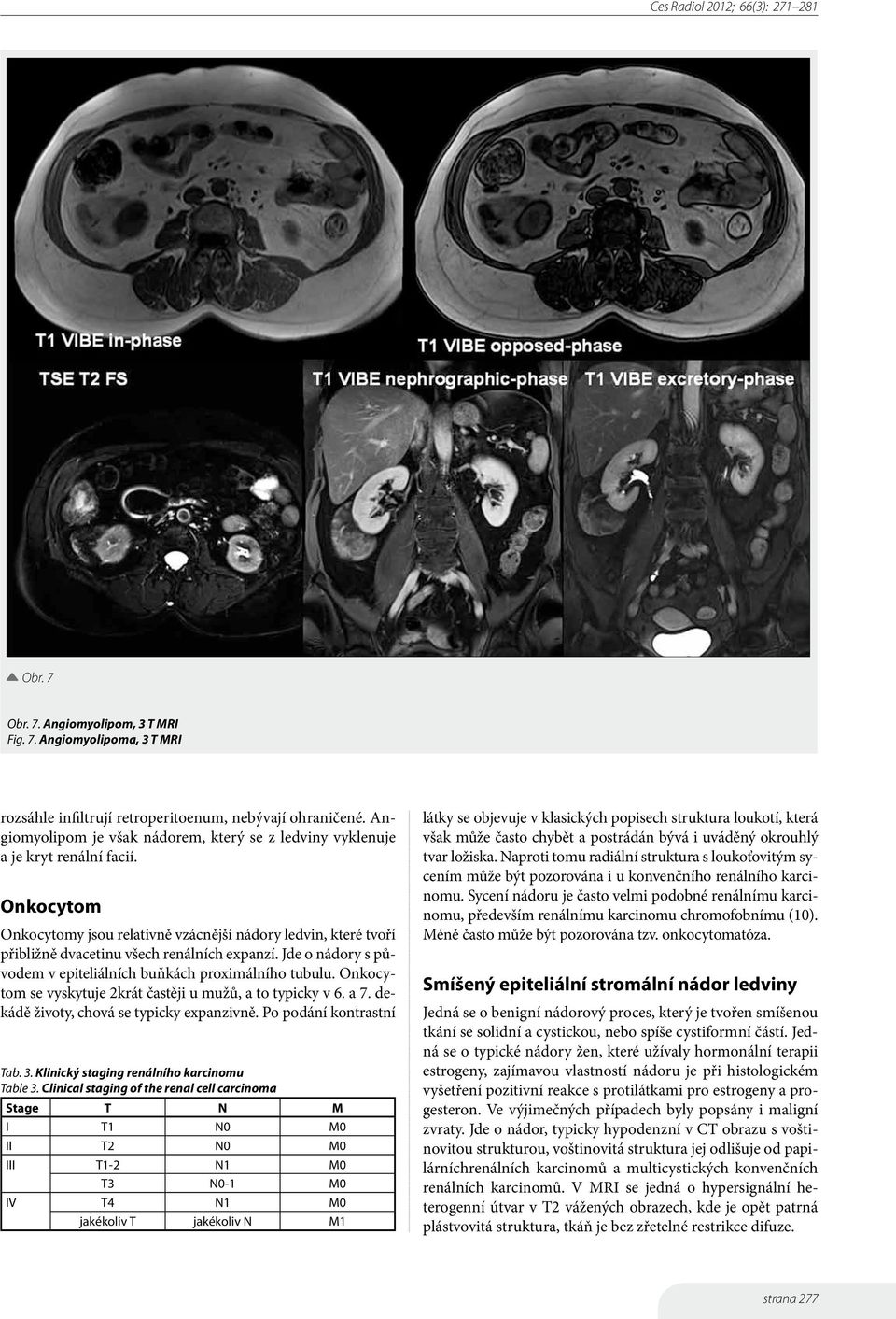 Onkocytom Onkocytomy jsou relativně vzácnější nádory ledvin, které tvoří přibližně dvacetinu všech renálních expanzí. Jde o nádory s původem v epiteliálních buňkách proximálního tubulu.