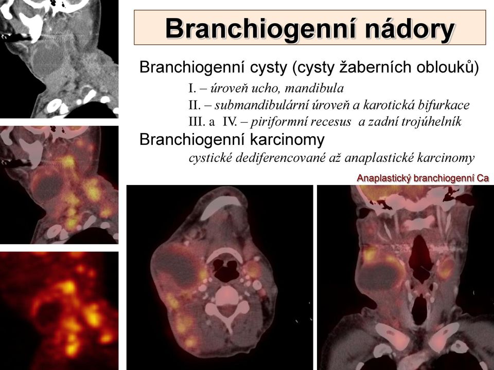 submandibulární úroveň a karotická bifurkace III. a IV.