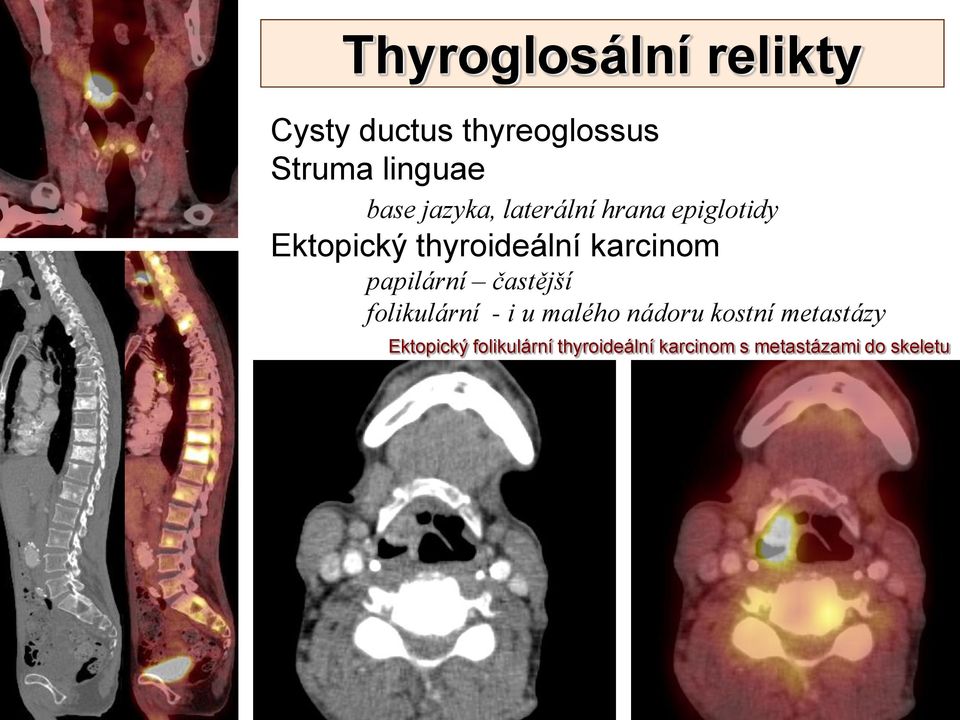 karcinom papilární častější folikulární - i u malého nádoru kostní