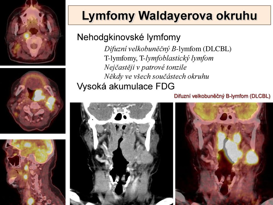 lymfom Nejčastěji v patrové tonzile Někdy ve všech