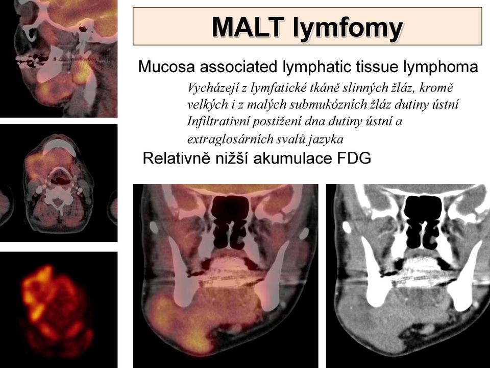 malých submukózních žláz dutiny ústní Infiltrativní postižení