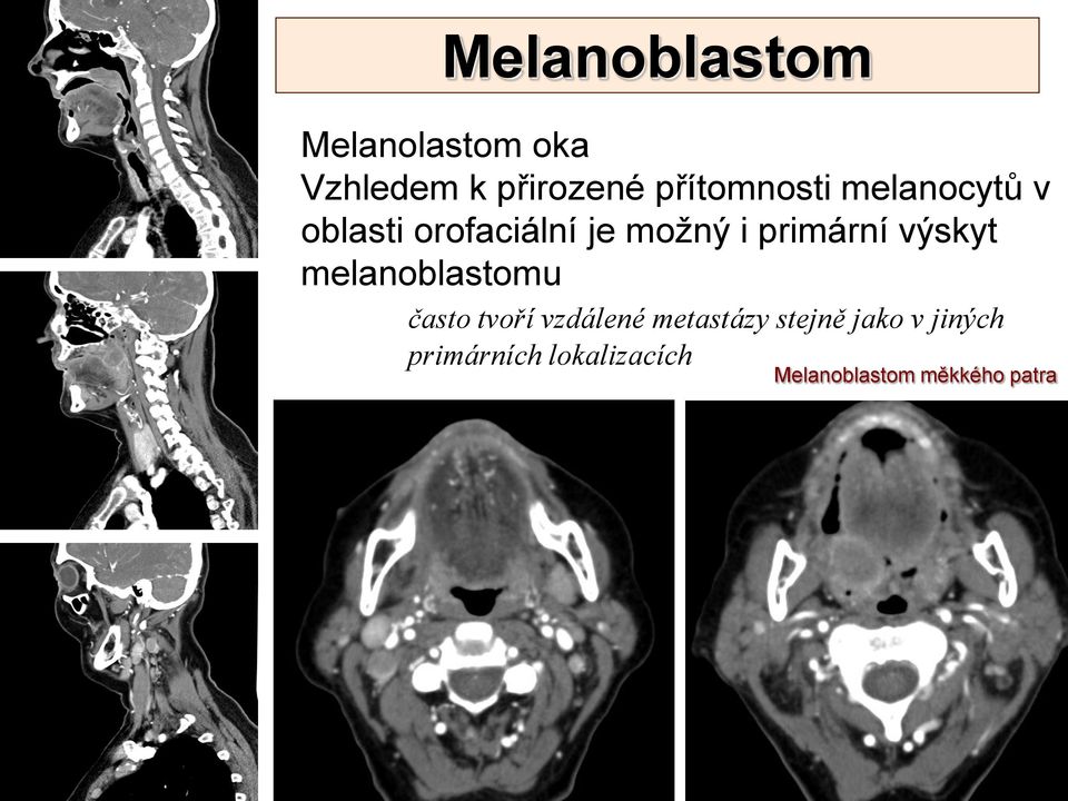 primární výskyt melanoblastomu často tvoří vzdálené
