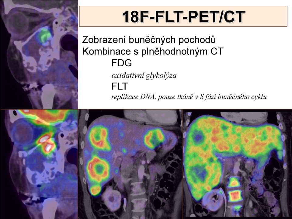 FDG oxidativní glykolýza FLT