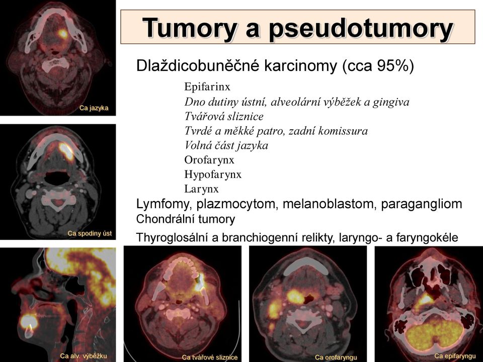 Orofarynx Hypofarynx Larynx Lymfomy, plazmocytom, melanoblastom, paragangliom Chondrální tumory