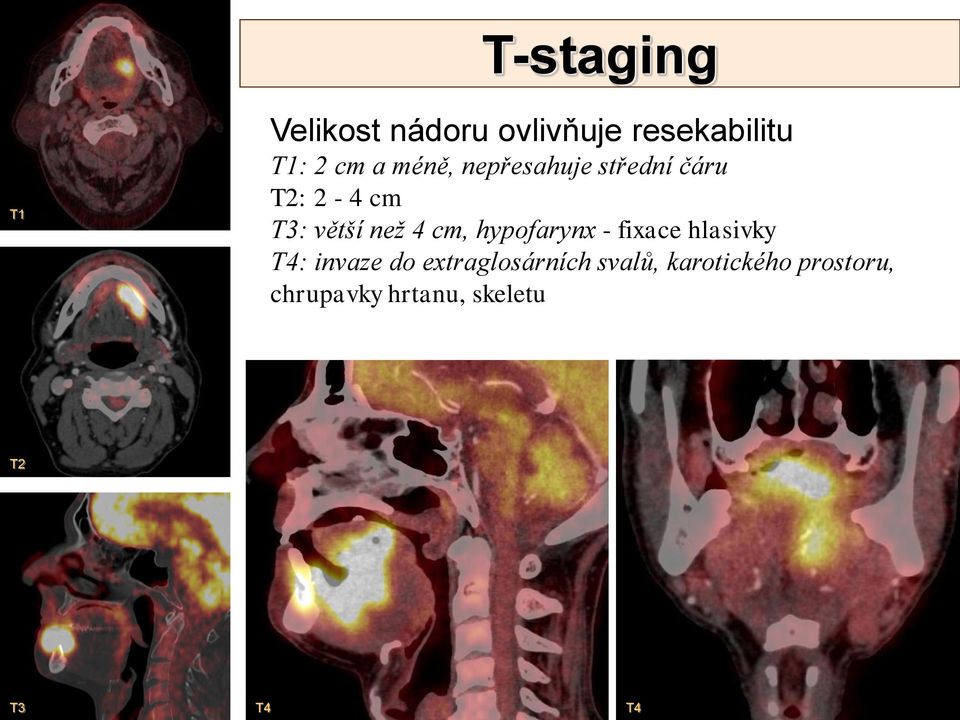 hypofarynx - fixace hlasivky T4: invaze do extraglosárních