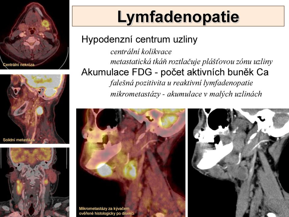 buněk Ca falešná pozitivita u reaktivní lymfadenopatie mikrometastázy - akumulace v