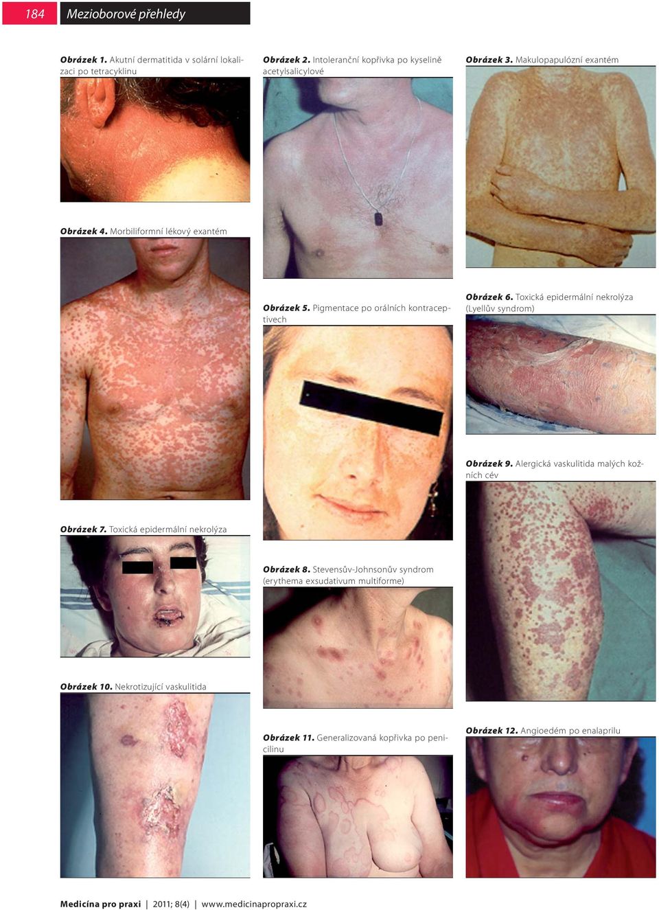 Toxická epidermální nekrolýza (Lyellův syndrom) Obrázek 9. Alergická vaskulitida malých kožních cév Obrázek 7. Toxická epidermální nekrolýza Obrázek 8.