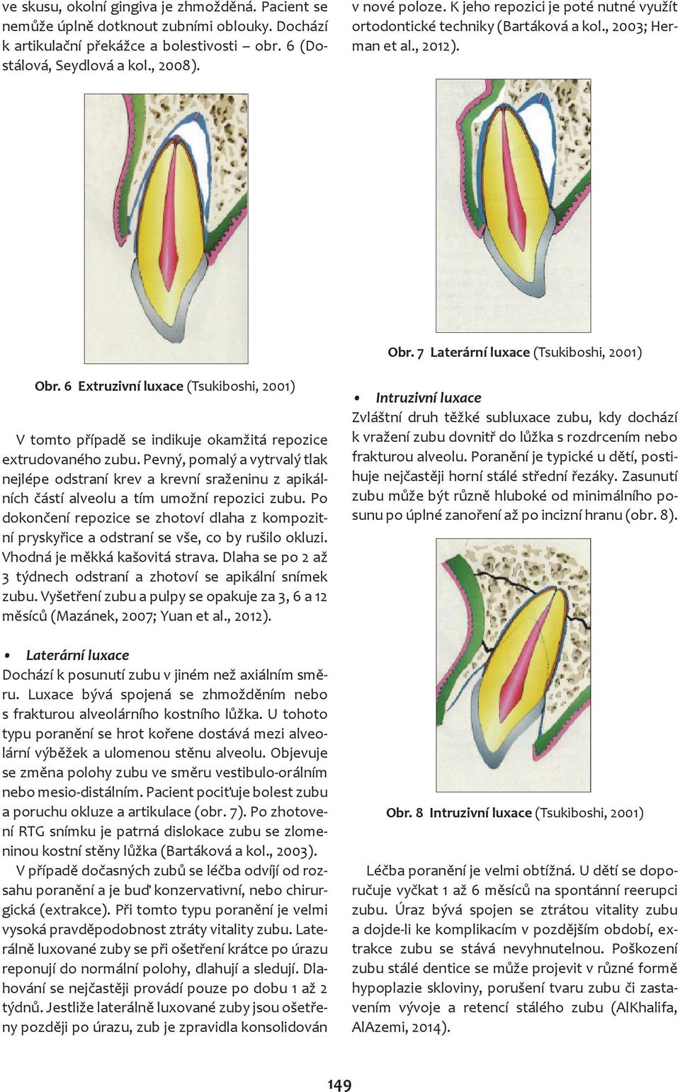 6 Extruzivní luxace (Tsukiboshi, 2001) V tomto případě se indikuje okamžitá repozice extrudovaného zubu.