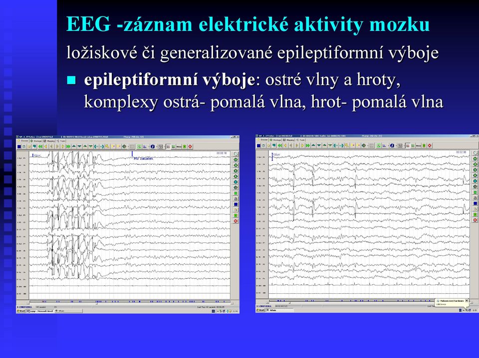 výboje epileptiformní výboje: ostré vlny a