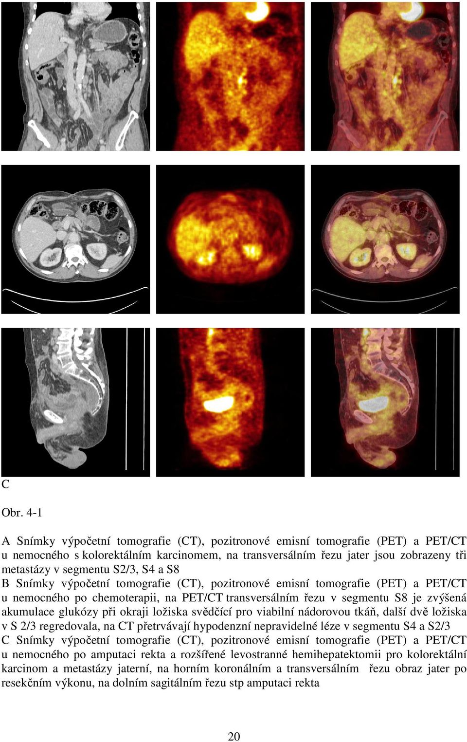 S4 a S8 B Snímky výpočetní tomografie (CT), pozitronové emisní tomografie (PET) a PET/CT u nemocného po chemoterapii, na PET/CT transversálním řezu v segmentu S8 je zvýšená akumulace glukózy při