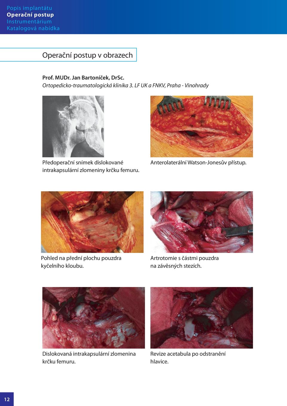 LF UK a FNKV, Praha - Vinohrady Předoperační snímek dislokované intrakapsulární zlomeniny krčku femuru.