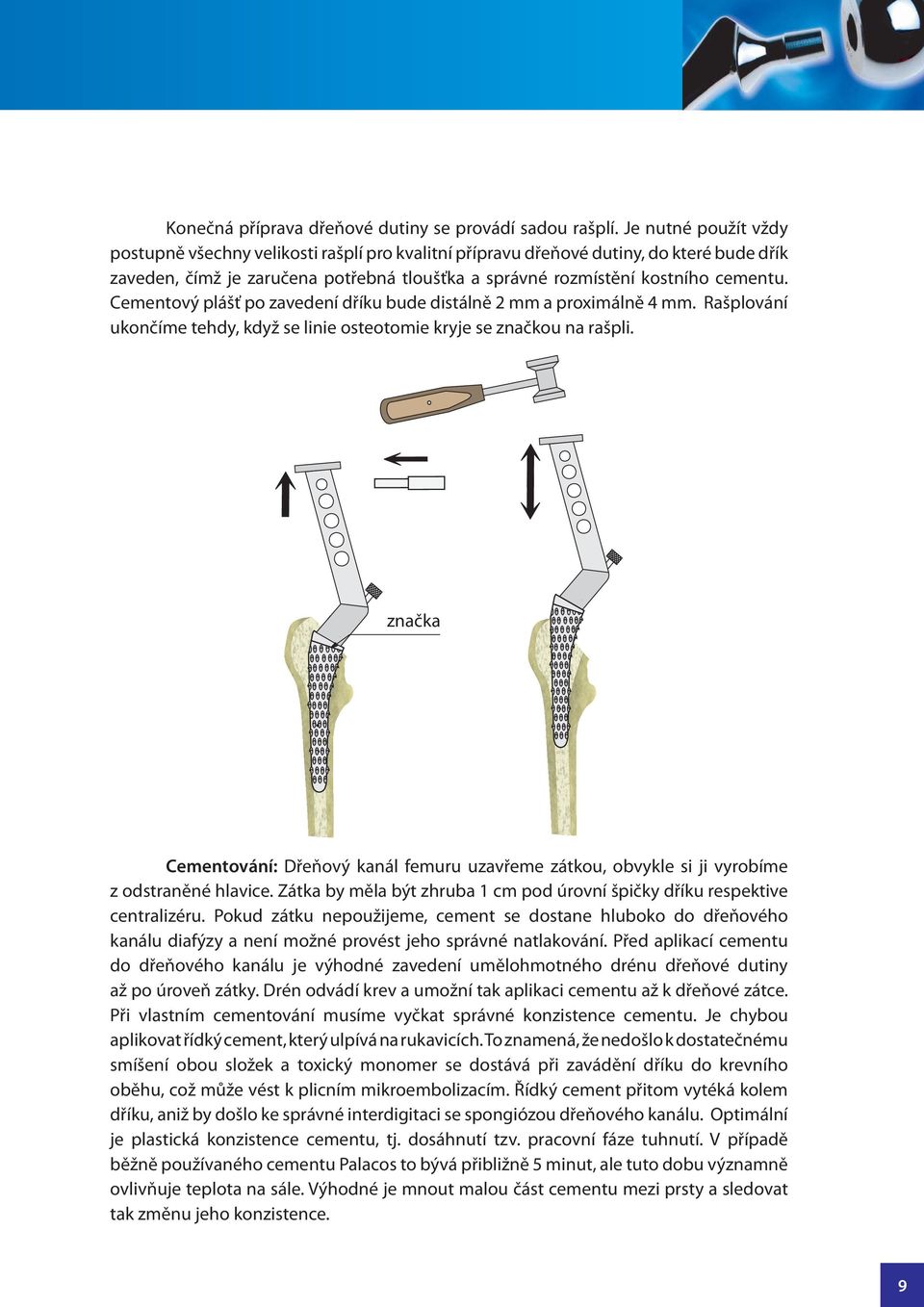 Cementový plášť po zavedení dříku bude distálně 2 mm a proximálně 4 mm. Rašplování ukončíme tehdy, když se linie osteotomie kryje se značkou na rašpli.