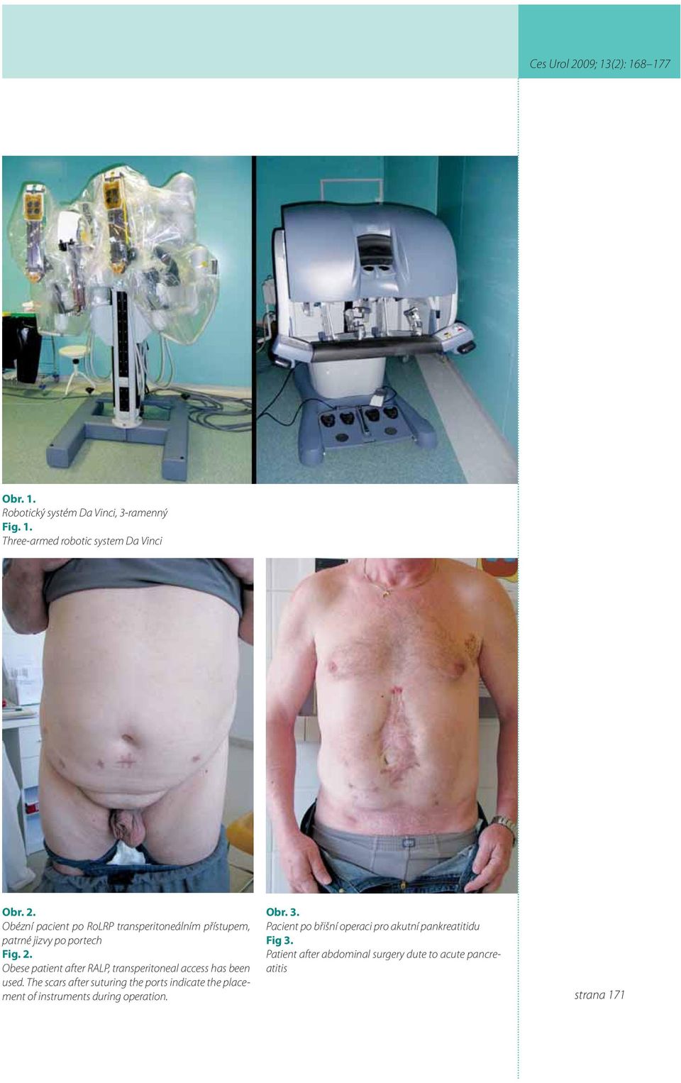 Obese patient after RALP, transperitoneal access has been used.