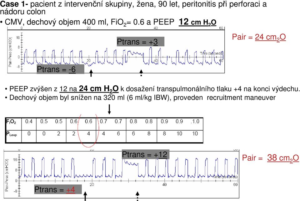6 a PEEP 12 cm H 2 O Ptrans = +3 Pair = 24 cm 2 O Ptrans = -6 PEEP zvýšen z 12 na 24 cm H 2 O k